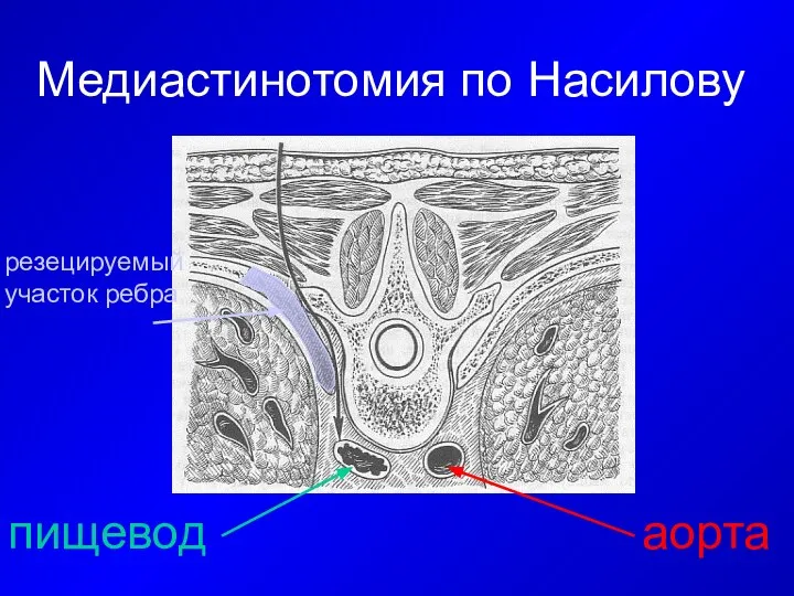 Медиастинотомия по Насилову аорта пищевод резецируемый участок ребра