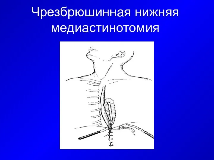 Чрезбрюшинная нижняя медиастинотомия