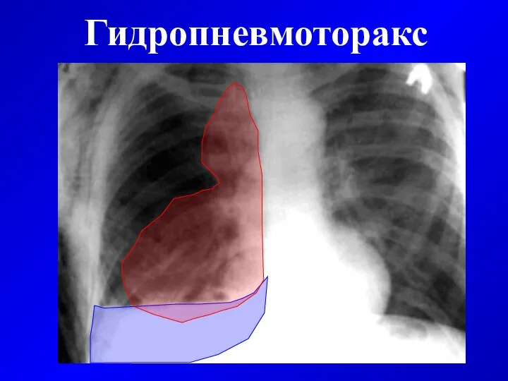 Гидропневмоторакс