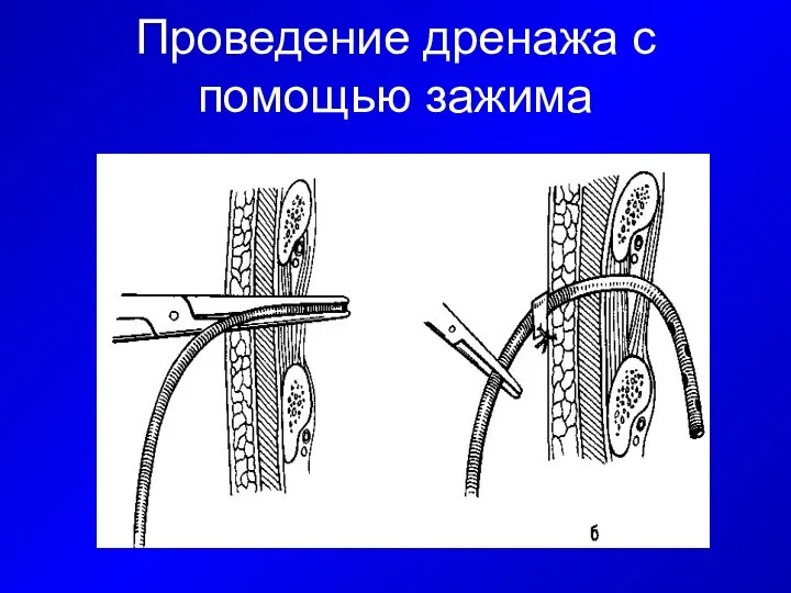 Проведение дренажа с помощью зажима