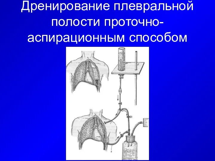 Дренирование плевральной полости проточно-аспирационным способом