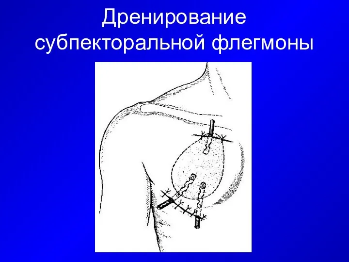 Дренирование субпекторальной флегмоны