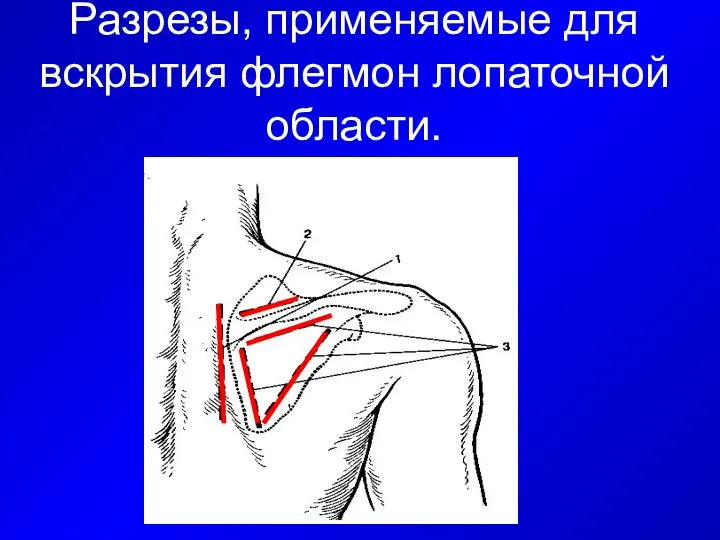 Разрезы, применяемые для вскрытия флегмон лопаточной области.