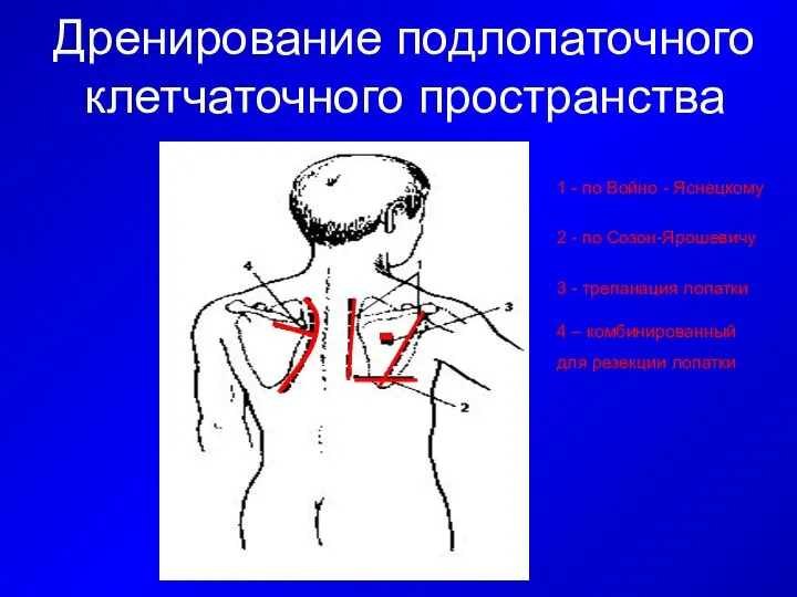 Дренирование подлопаточного клетчаточного пространства 1 - по Войно - Яснецкому 2 -