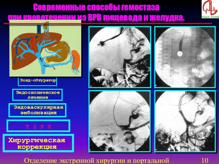 Отделение экстренной хирургии и портальной гипертензии Лекарственная терапия Зонд-обтуратор Эндоскопическое лечение Эндоваскулярная