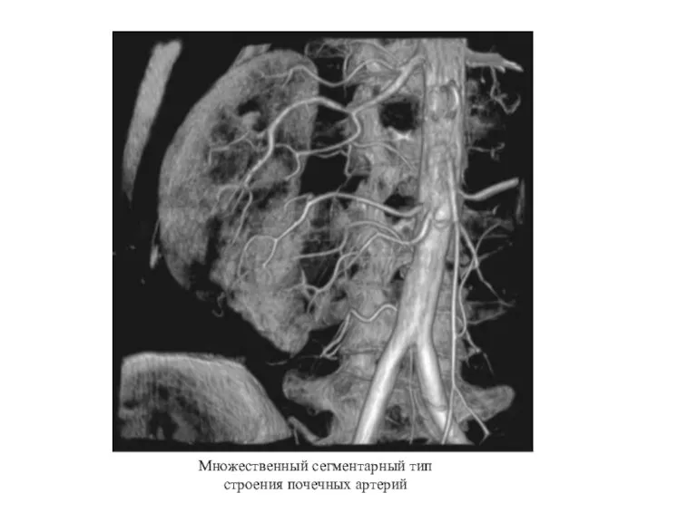 Множественный сегментарный тип строения почечных артерий