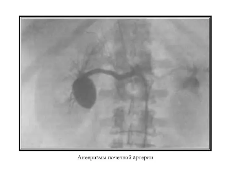 Аневризмы почечной артерии
