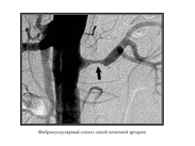 Фибромускулярный стеноз левой почечной артерии