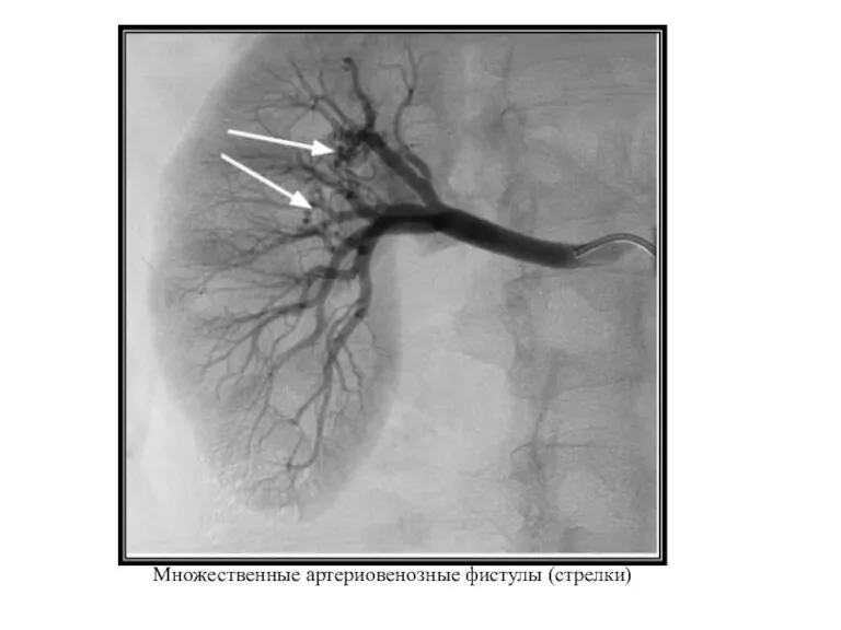 Множественные артериовенозные фистулы (стрелки)