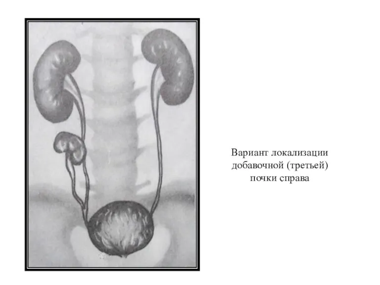 Вариант локализации добавочной (третьей) почки справа