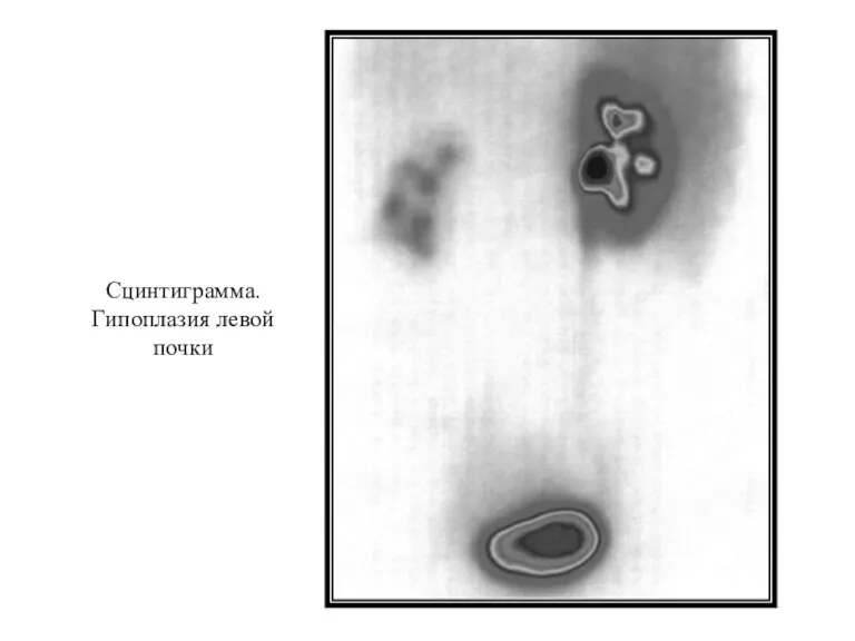 Сцинтиграмма. Гипоплазия левой почки