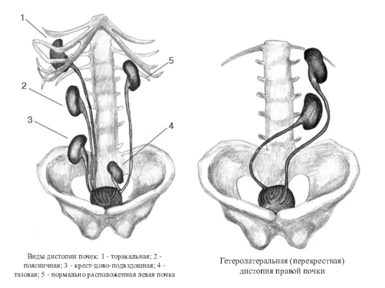 Виды дистопии почек: 1 - торакальная; 2 - поясничная; 3 - крест-цово-подвздошная;