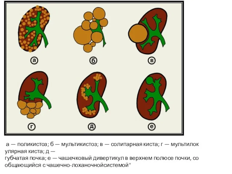 а — поликистоз; б — мультикистоз; в — солитарная киста; г —