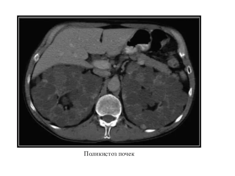 Поликистоз почек