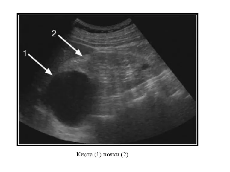 Киста (1) почки (2)