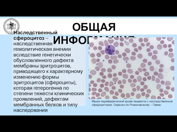 Наследственный сфероцитоз – наследственная гемолитическая анемия вследствие генетически обусловленного дефекта мембраны эритроцитов,