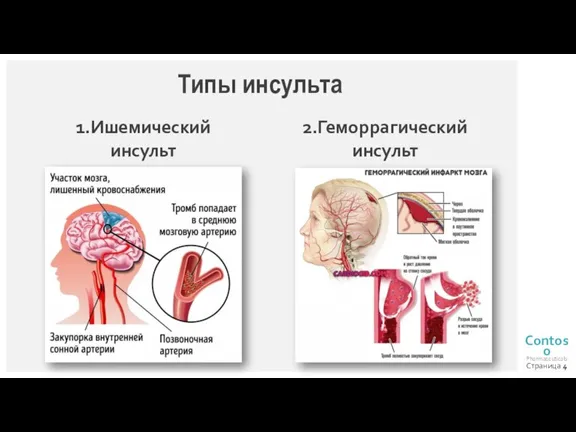 Типы инсульта 1.Ишемический инсульт 2.Геморрагический инсульт Страница