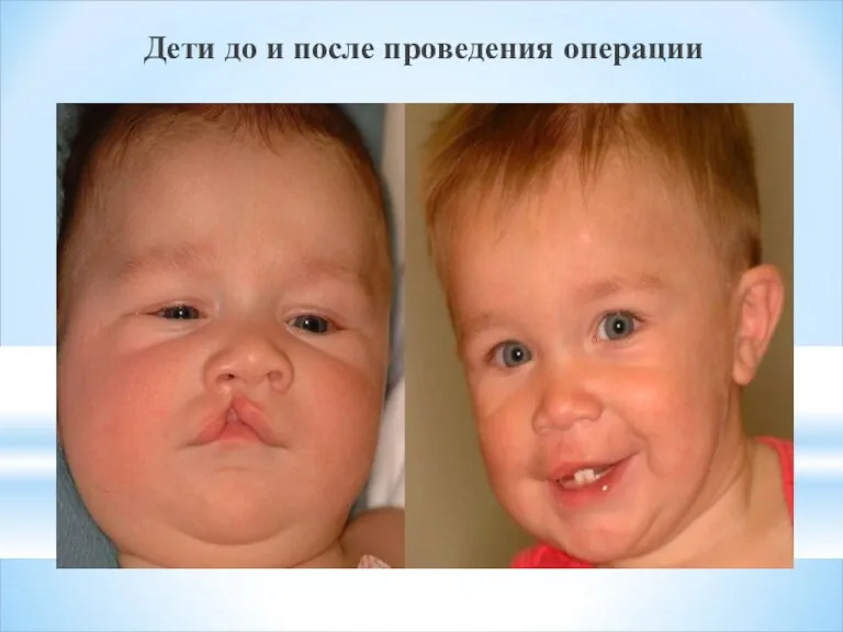 Дети до и после проведения операции