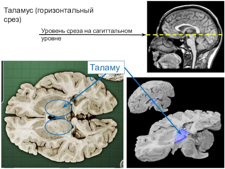 Таламус (горизонтальный срез) Таламус Уровень среза на сагиттальном уровне