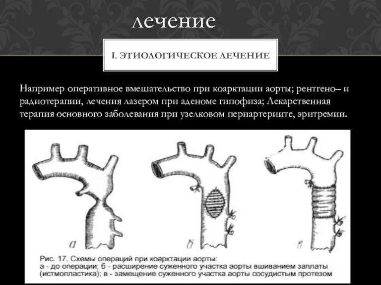 Например оперативное вмешательство при коарктации аорты; рентгено– и радиотерапии, лечения лазером при