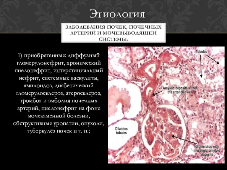 1) приобретенные: диффузный гломерулонефрит, хронический пиелонефрит, интерстициальный нефрит, системные васкулиты, амилоидоз, диабетический