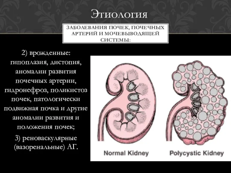 2) врожденные: гипоплазия, дистопия, аномалии развития почечных артерии, гидронефроз, поликистоз почек, патологически