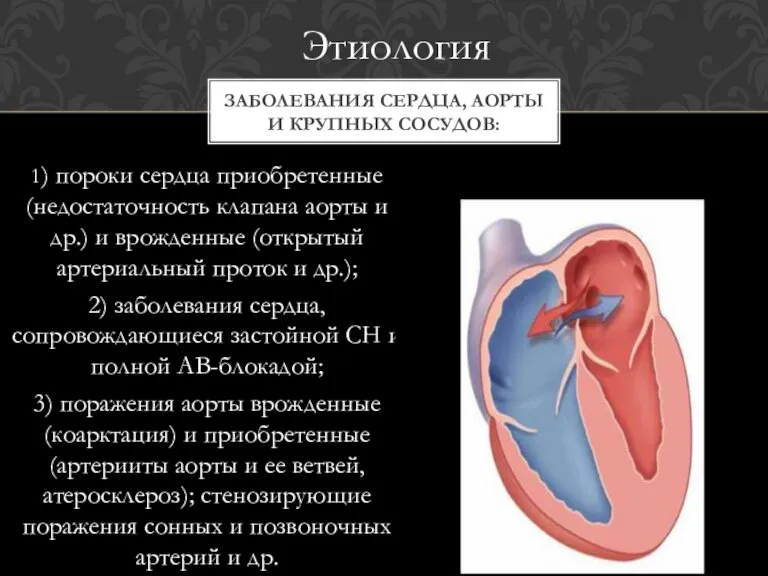 1) пороки сердца приобретенные (недостаточность клапана аорты и др.) и врожденные (открытый