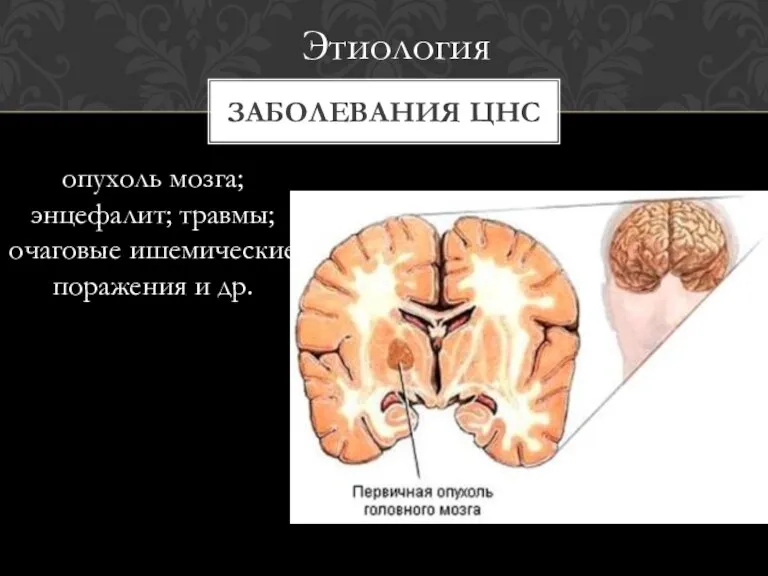 опухоль мозга; энцефалит; травмы; очаговые ишемические поражения и др. ЗАБОЛЕВАНИЯ ЦНС Этиология