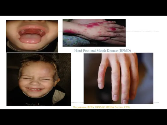 Hand-Foot-and-Mouth Disease (HFMD) По данным ФГБУ НИИДИ ФМБА России, СПб