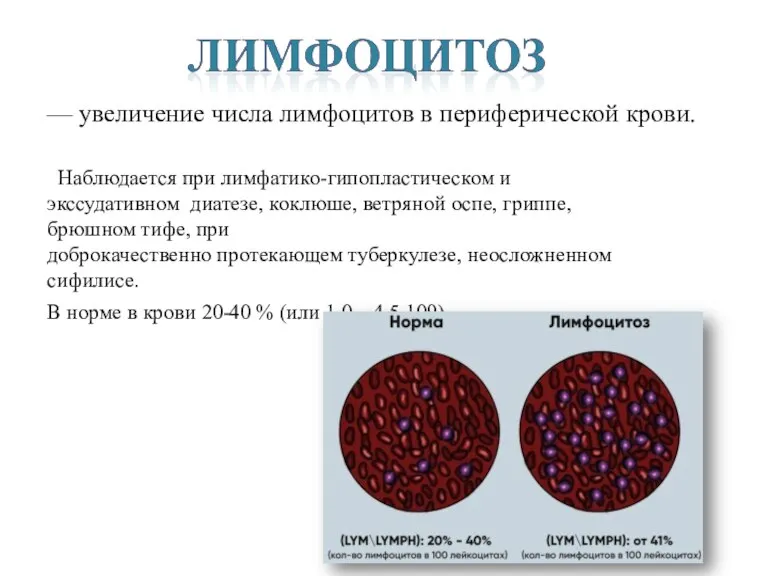 — увеличение числа лимфоцитов в периферической крови. Наблюдается при лимфатико-гипопластическом и экссудативном