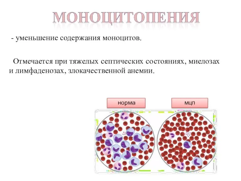 - уменьшение содержания моноцитов. Отмечается при тяжелых септических состояниях, миелозах и лимфаденозах, злокачественной анемии. норма мцп