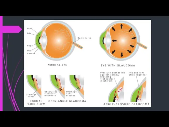 Glaucoma