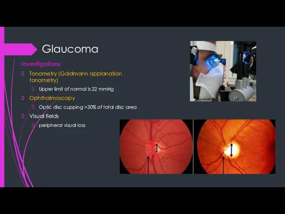 Glaucoma Investigations Tonometry (Goldmann applanation tonometry) Upper limit of normal is 22