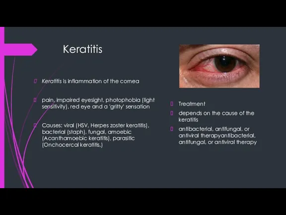 Keratitis Keratitis is inflammation of the cornea pain, impaired eyesight, photophobia (light