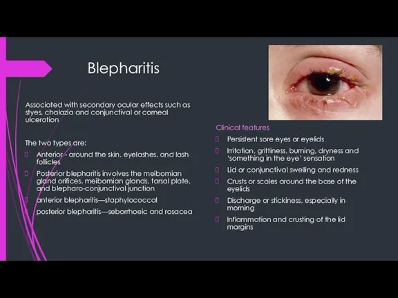 Blepharitis Clinical features Persistent sore eyes or eyelids Irritation, grittiness, burning, dryness