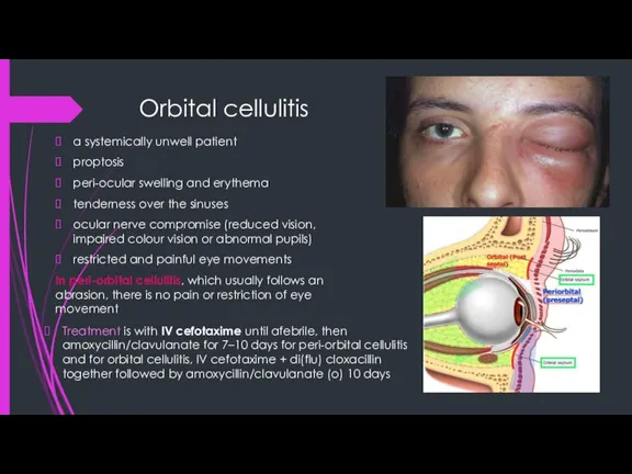 Orbital cellulitis a systemically unwell patient proptosis peri-ocular swelling and erythema tenderness