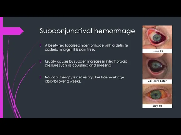 Subconjunctival hemorrhage A beefy red localised haemorrhage with a definite posterior margin,