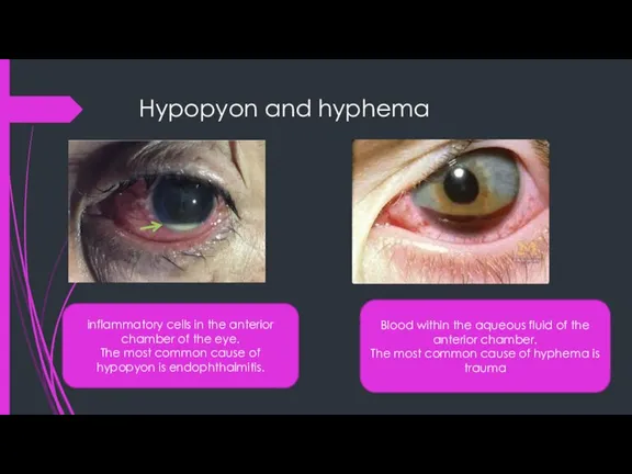 Hypopyon and hyphema inflammatory cells in the anterior chamber of the eye.