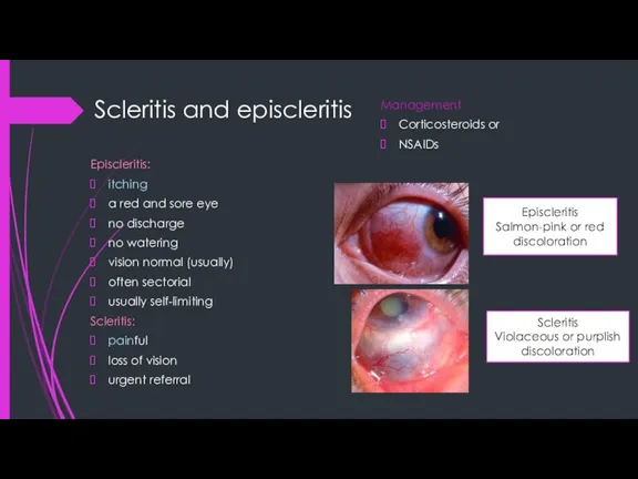 Scleritis and episcleritis Episcleritis: itching a red and sore eye no discharge