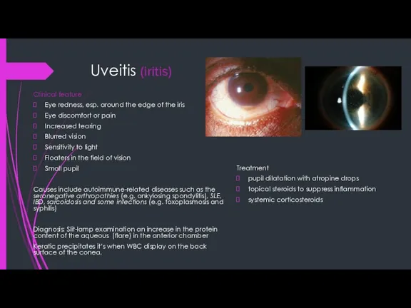 Uveitis (iritis) Clinical feature Eye redness, esp. around the edge of the