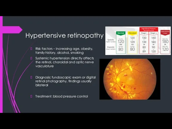 Hypertensive retinopathy Risk factors – increasing age, obesity, family history, alcohol, smoking