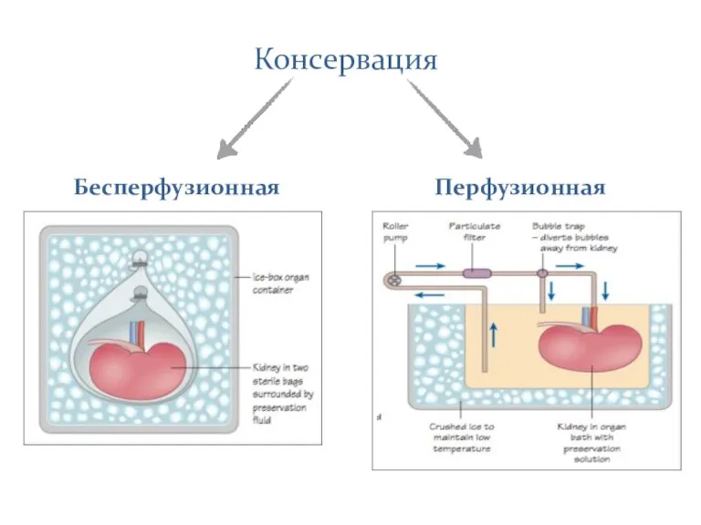 Консервация Бесперфузионная Перфузионная