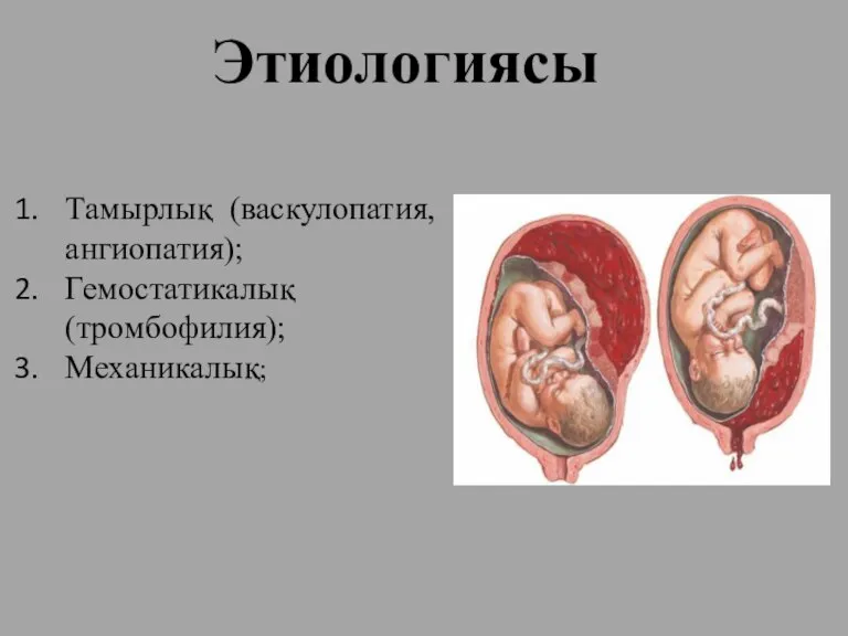 Этиологиясы Тамырлық (васкулопатия, ангиопатия); Гемостатикалық (тромбофилия); Механикалық;