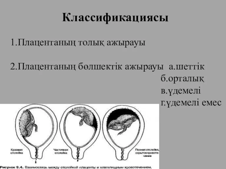 Классификациясы 1.Плацентаның толық ажырауы 2.Плацентаның бөлшектік ажырауы а.шеттік б.орталық в.үдемелі г.үдемелі емес