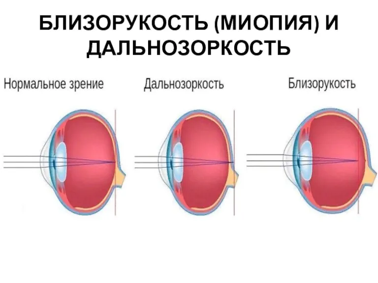 БЛИЗОРУКОСТЬ (МИОПИЯ) И ДАЛЬНОЗОРКОСТЬ