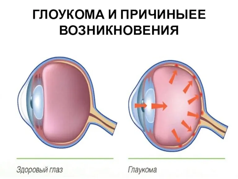 ГЛОУКОМА И ПРИЧИНЫЕЕ ВОЗНИКНОВЕНИЯ