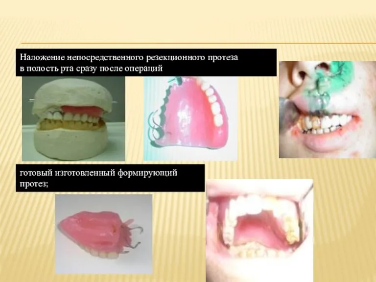 Наложение непосредственного резекционного протеза в полость рта сразу после операций готовый изготовленный формирующий протез;