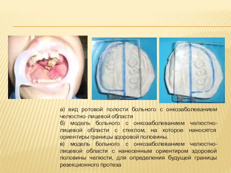 а) вид ротовой полости больного с онкозаболеванием челюстно-лицевой области б) модель больного