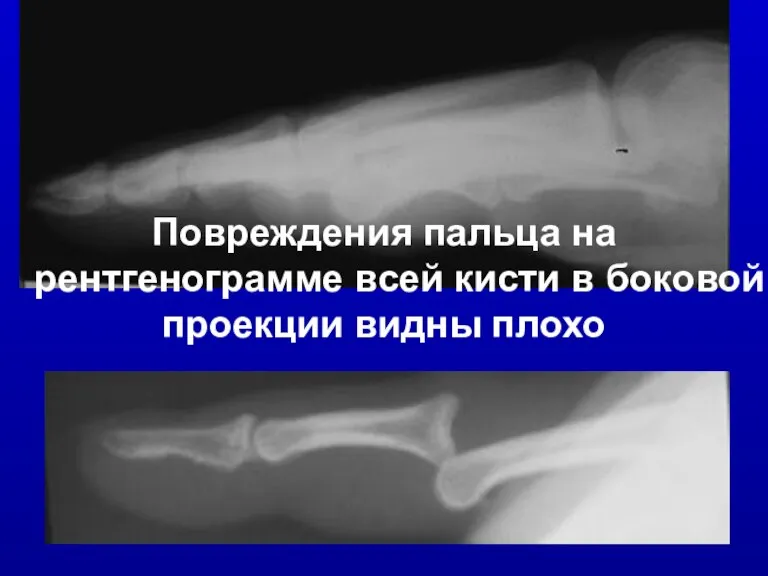 Повреждения пальца на рентгенограмме всей кисти в боковой проекции видны плохо