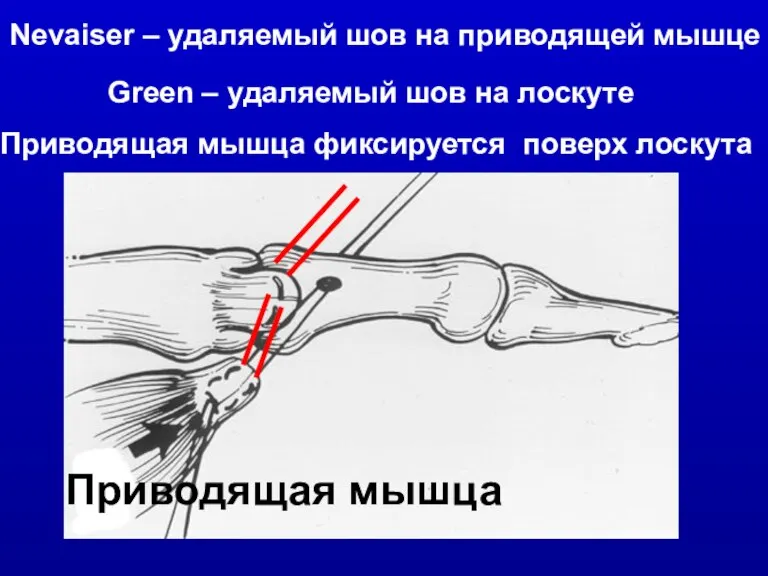 Приводящая мышца Nevaiser – удаляемый шов на приводящей мышце Green – удаляемый шов на лоскуте